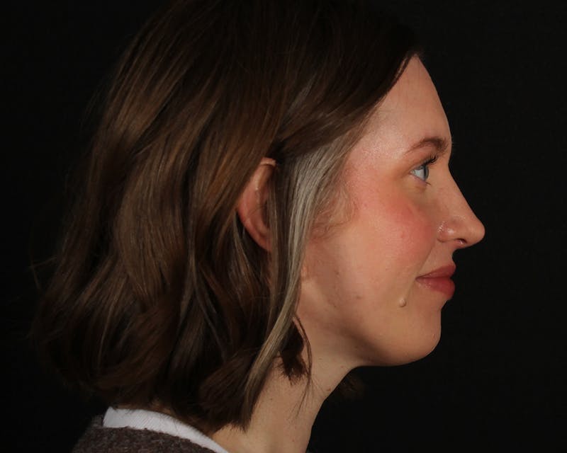 Rhinoplasty Female Before & After Gallery - Patient 378577 - Image 14