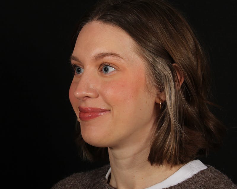 Rhinoplasty Female Before & After Gallery - Patient 378577 - Image 4