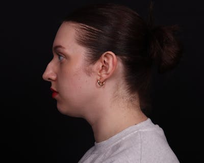 Rhinoplasty Female Before & After Gallery - Patient 378577 - Image 1
