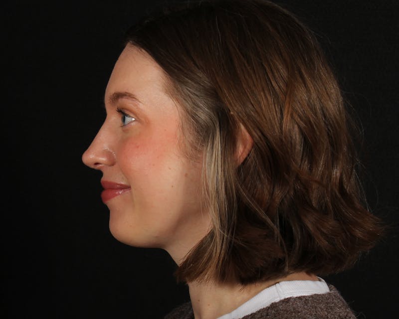 Rhinoplasty Female Before & After Gallery - Patient 378577 - Image 2