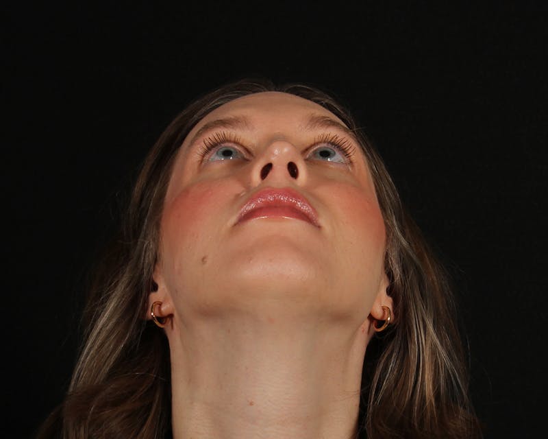 Rhinoplasty Female Before & After Gallery - Patient 378577 - Image 10