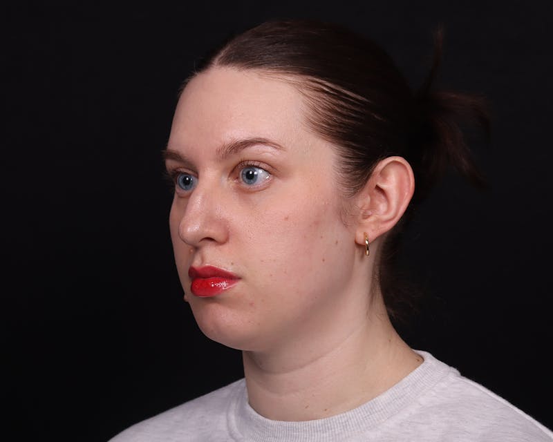 Rhinoplasty Female Before & After Gallery - Patient 378577 - Image 3