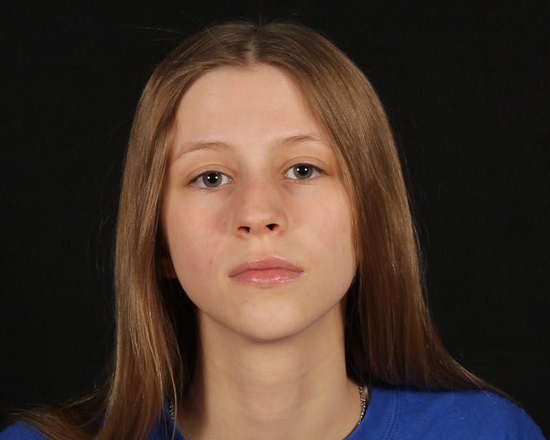 Rhinoplasty Female Before & After Gallery - Patient 223428 - Image 5