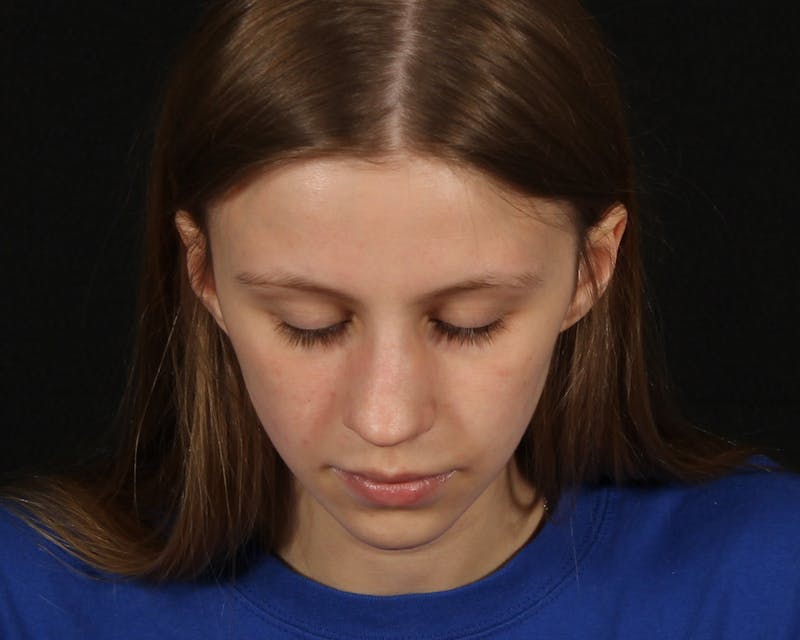 Rhinoplasty Female Before & After Gallery - Patient 223428 - Image 7