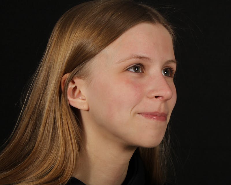 Rhinoplasty Female Before & After Gallery - Patient 223428 - Image 10