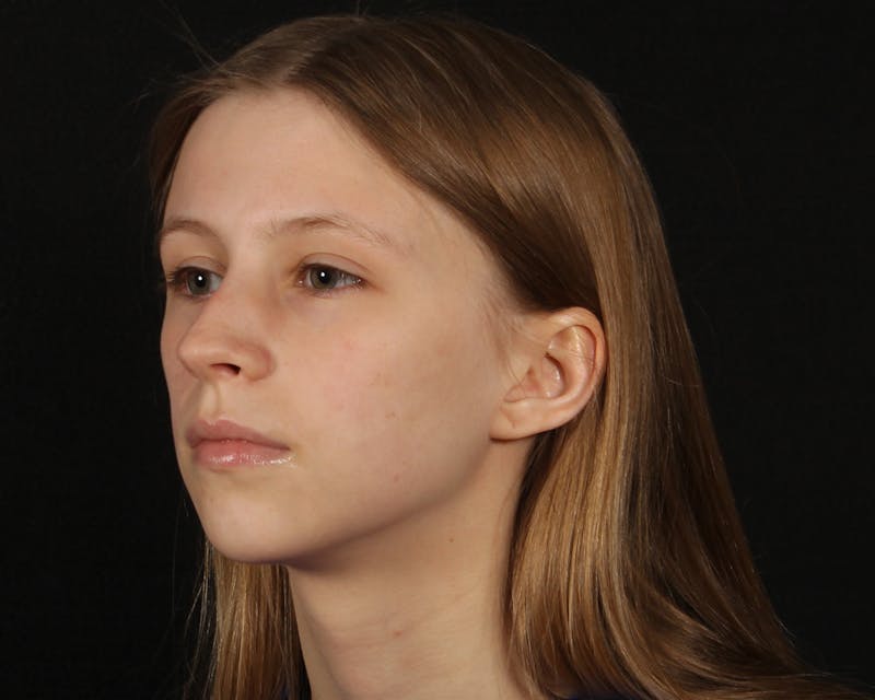 Rhinoplasty Female Before & After Gallery - Patient 223428 - Image 3