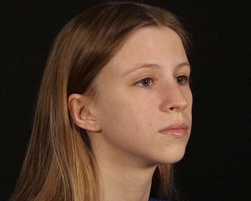 Rhinoplasty Female Before & After Gallery - Patient 223428 - Image 9