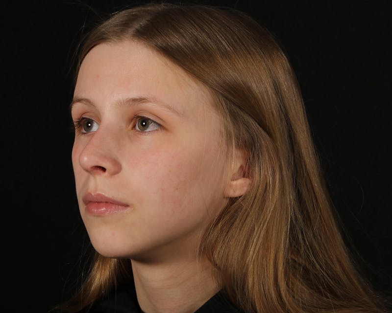 Rhinoplasty Female Before & After Gallery - Patient 223428 - Image 4