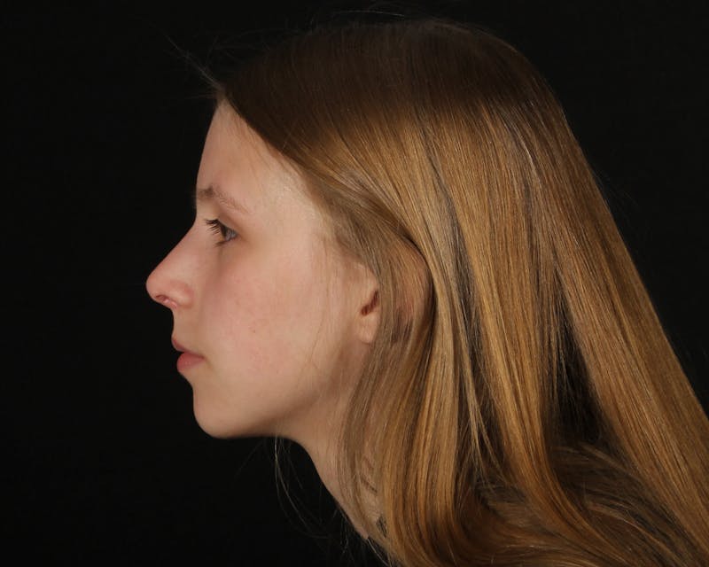Rhinoplasty Female Before & After Gallery - Patient 223428 - Image 2