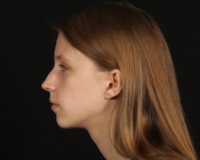 Rhinoplasty Female Before & After Gallery - Patient 223428 - Image 1