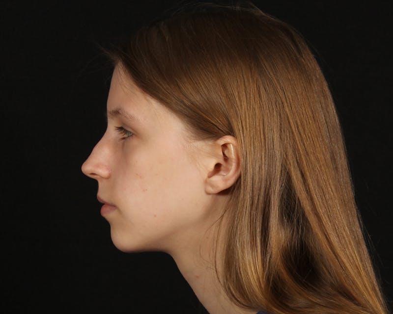 Rhinoplasty Female Before & After Gallery - Patient 223428 - Image 1