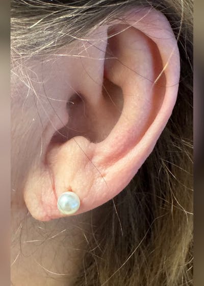 Earlobe Repair Before & After Gallery - Patient 189029 - Image 2