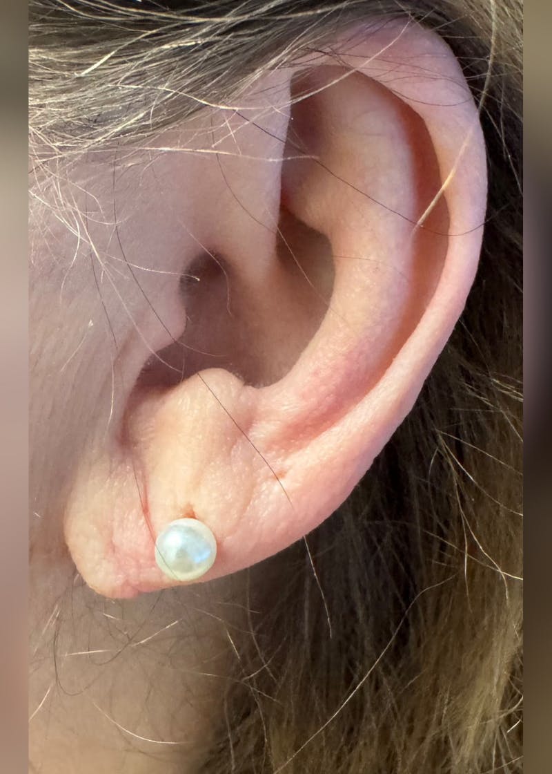 Earlobe Repair Before & After Gallery - Patient 189029 - Image 2