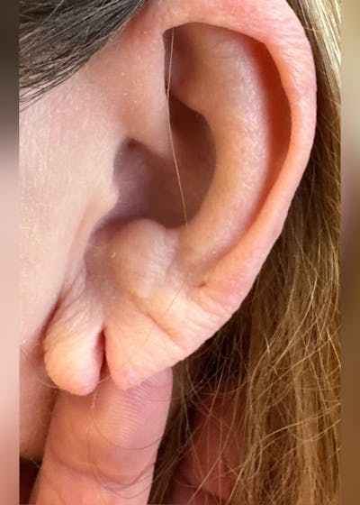 Earlobe Repair Before & After Gallery - Patient 189029 - Image 1