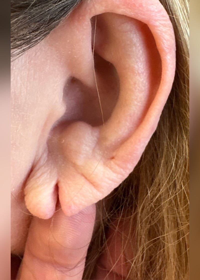 Earlobe Repair Before & After Gallery - Patient 189029 - Image 1
