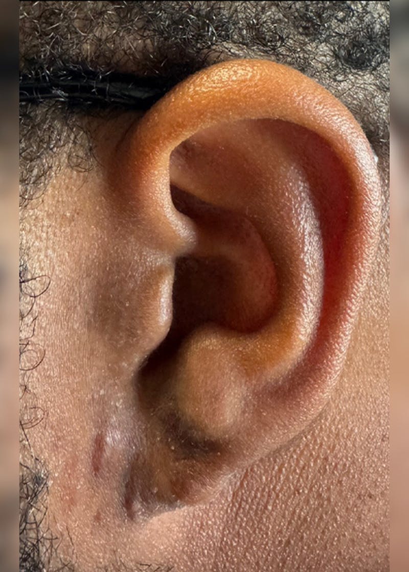 Facial Lesion/Keloid Removal Before & After Gallery - Patient 114145 - Image 2