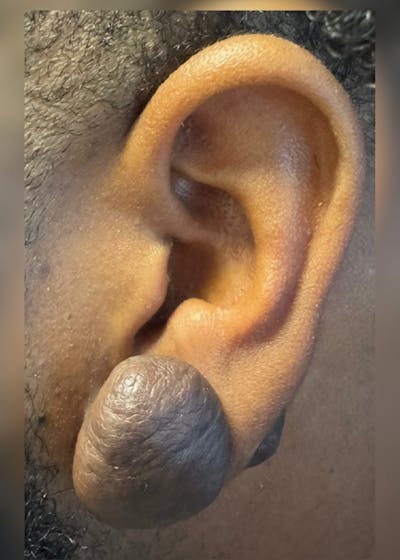 Facial Lesion/Keloid Removal Before & After Gallery - Patient 114145 - Image 1