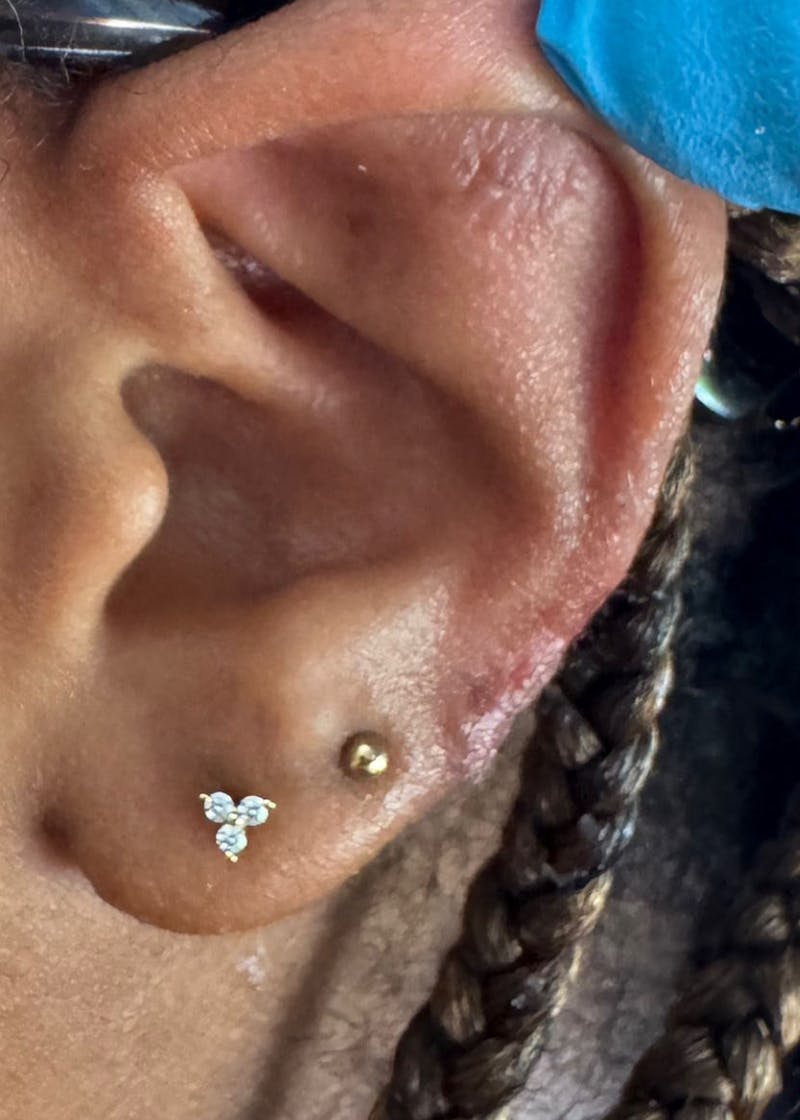 Facial Lesion/Keloid Removal Before & After Gallery - Patient 217851 - Image 2