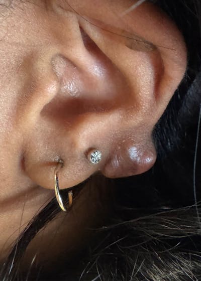 Facial Lesion/Keloid Removal Before & After Gallery - Patient 217851 - Image 1