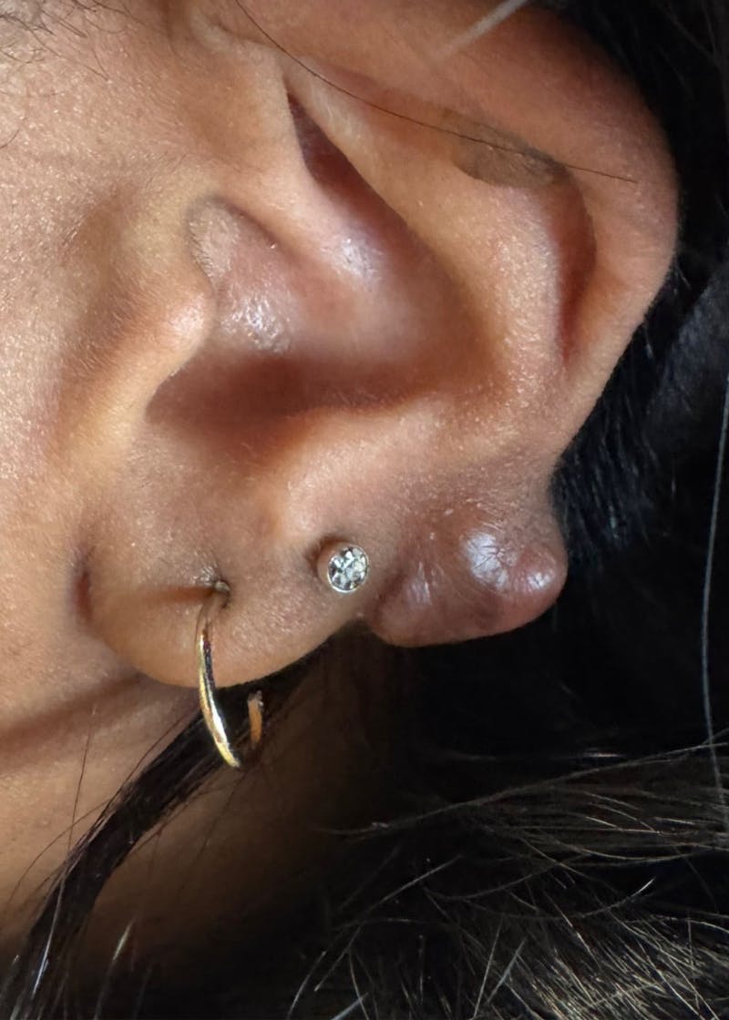 Facial Lesion/Keloid Removal Before & After Gallery - Patient 217851 - Image 1