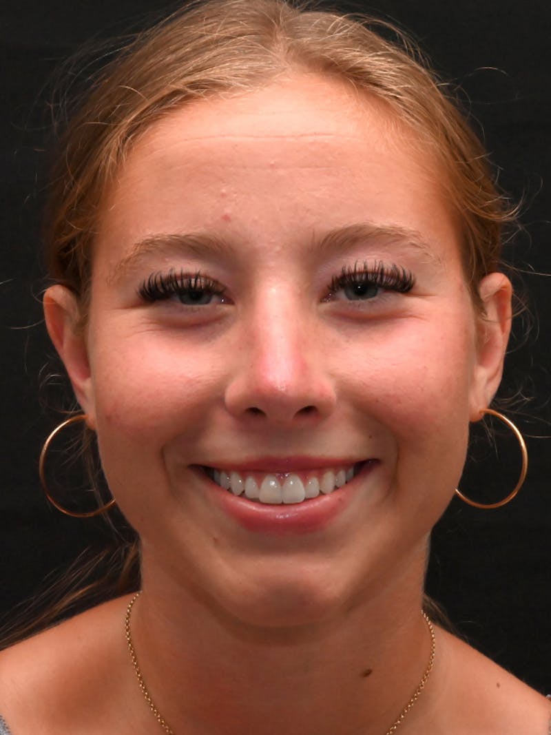 Rhinoplasty Before & After Gallery - Patient 394460 - Image 4