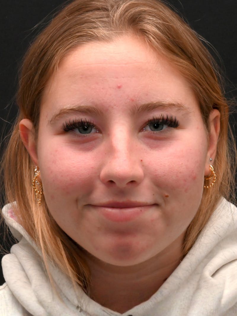 Rhinoplasty Before & After Gallery - Patient 394460 - Image 3