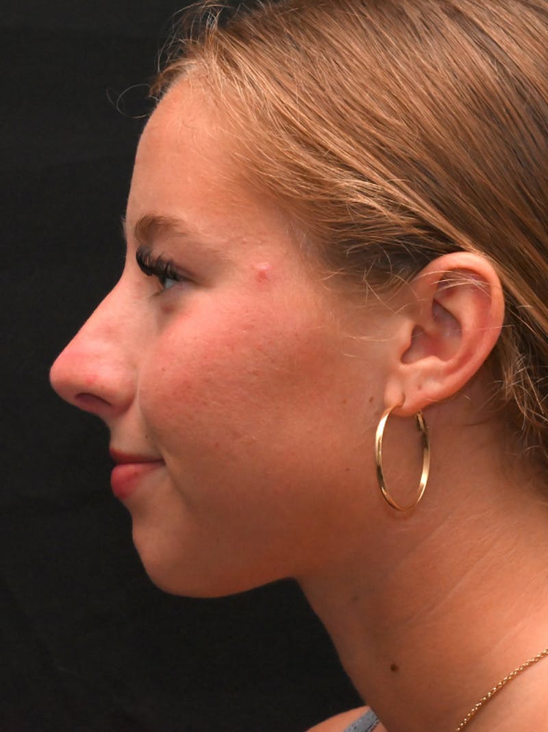 Rhinoplasty Before & After Gallery - Patient 394460 - Image 10