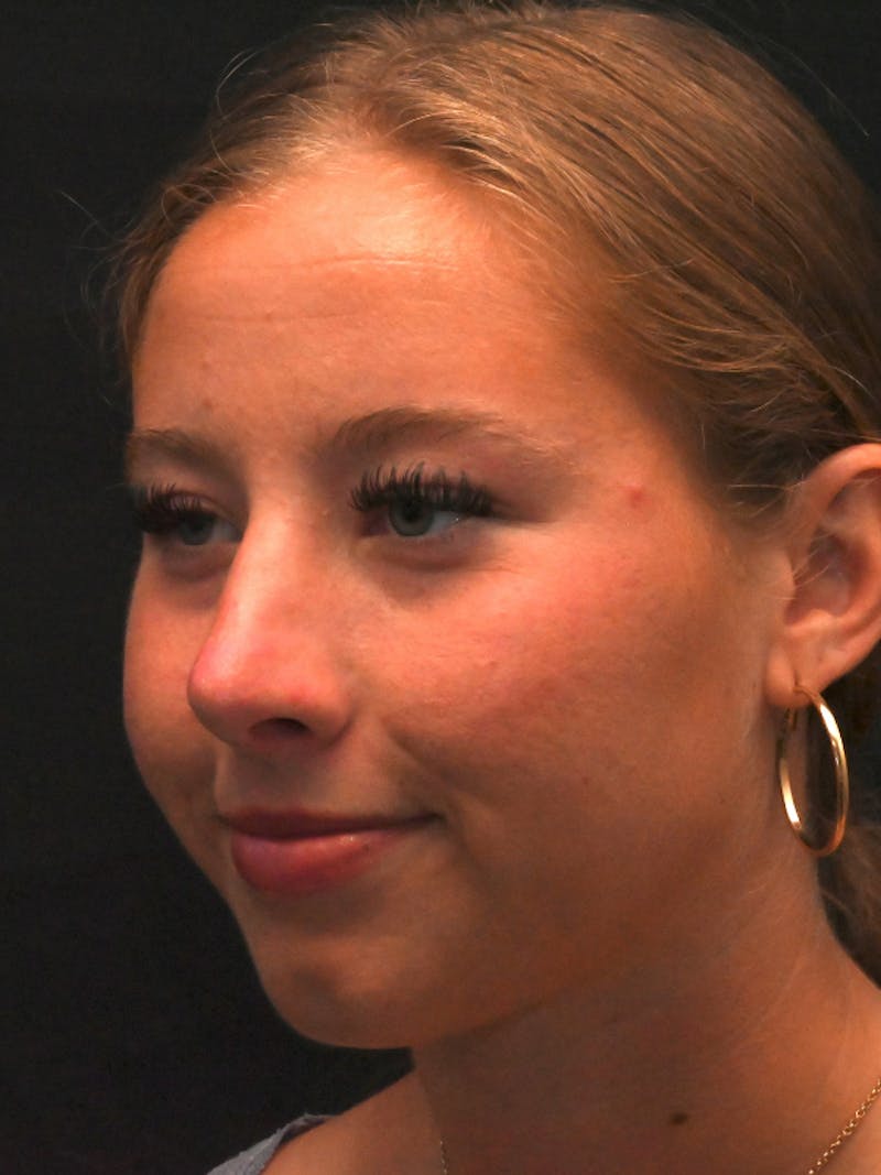 Rhinoplasty Before & After Gallery - Patient 394460 - Image 8