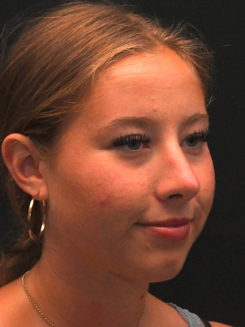 Rhinoplasty Before & After Gallery - Patient 394460 - Image 6