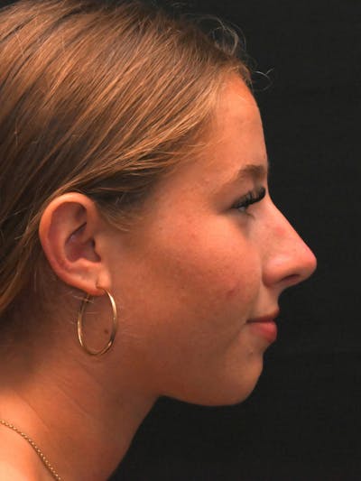 Rhinoplasty Before & After Gallery - Patient 394460 - Image 2