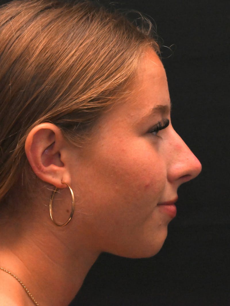 Rhinoplasty Before & After Gallery - Patient 394460 - Image 2