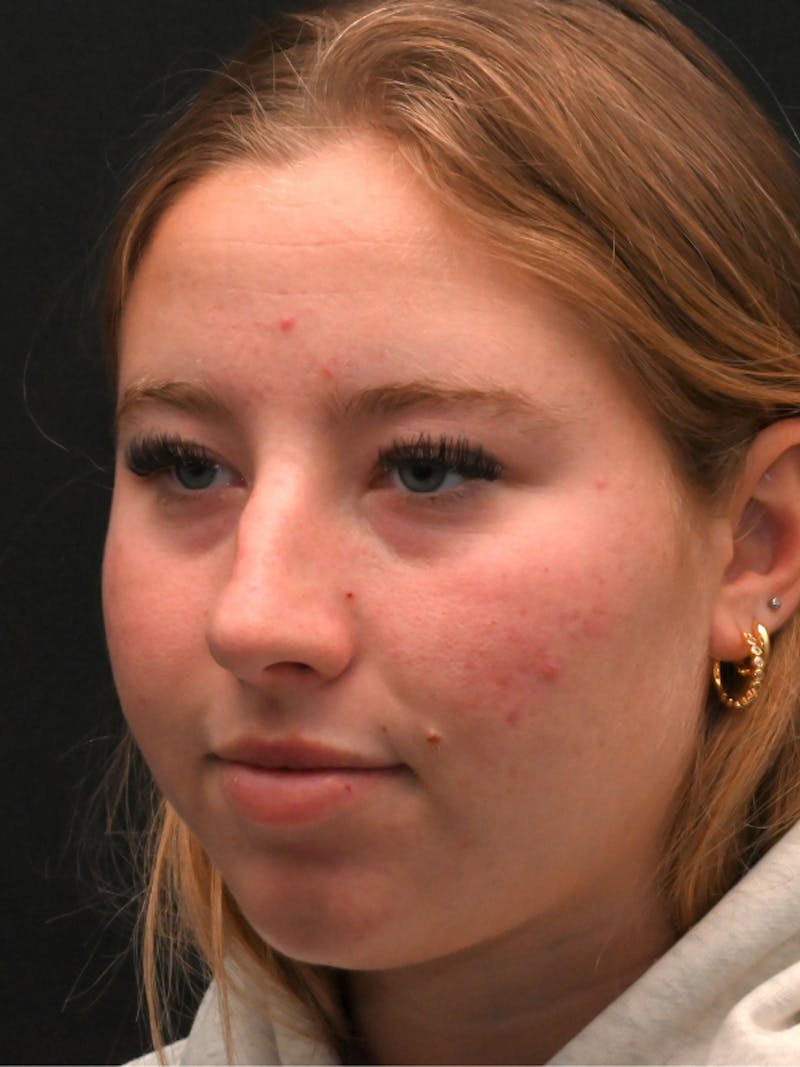 Rhinoplasty Before & After Gallery - Patient 394460 - Image 7