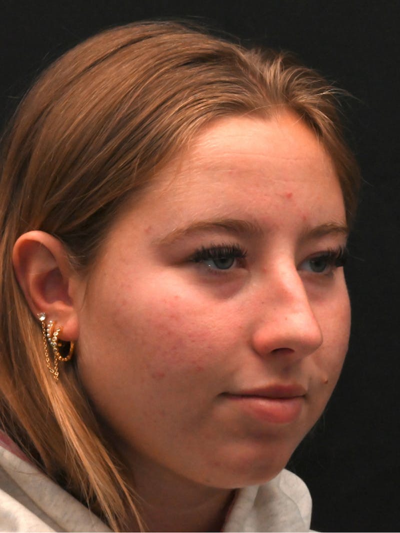 Rhinoplasty Before & After Gallery - Patient 394460 - Image 5