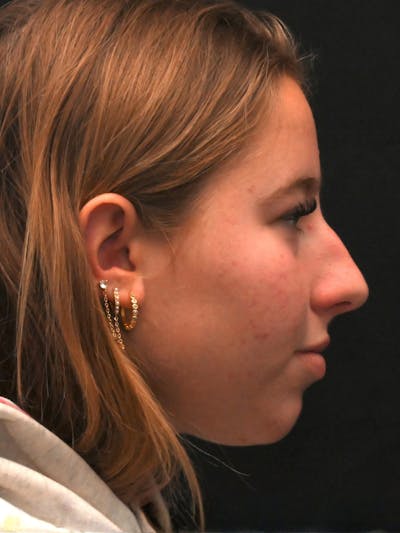 Rhinoplasty Before & After Gallery - Patient 394460 - Image 1