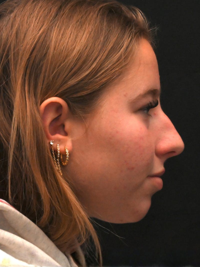 Rhinoplasty Before & After Gallery - Patient 394460 - Image 1