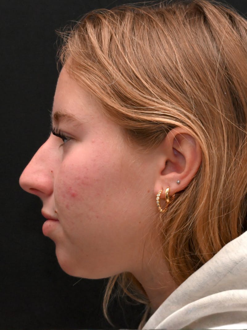 Rhinoplasty Before & After Gallery - Patient 394460 - Image 9