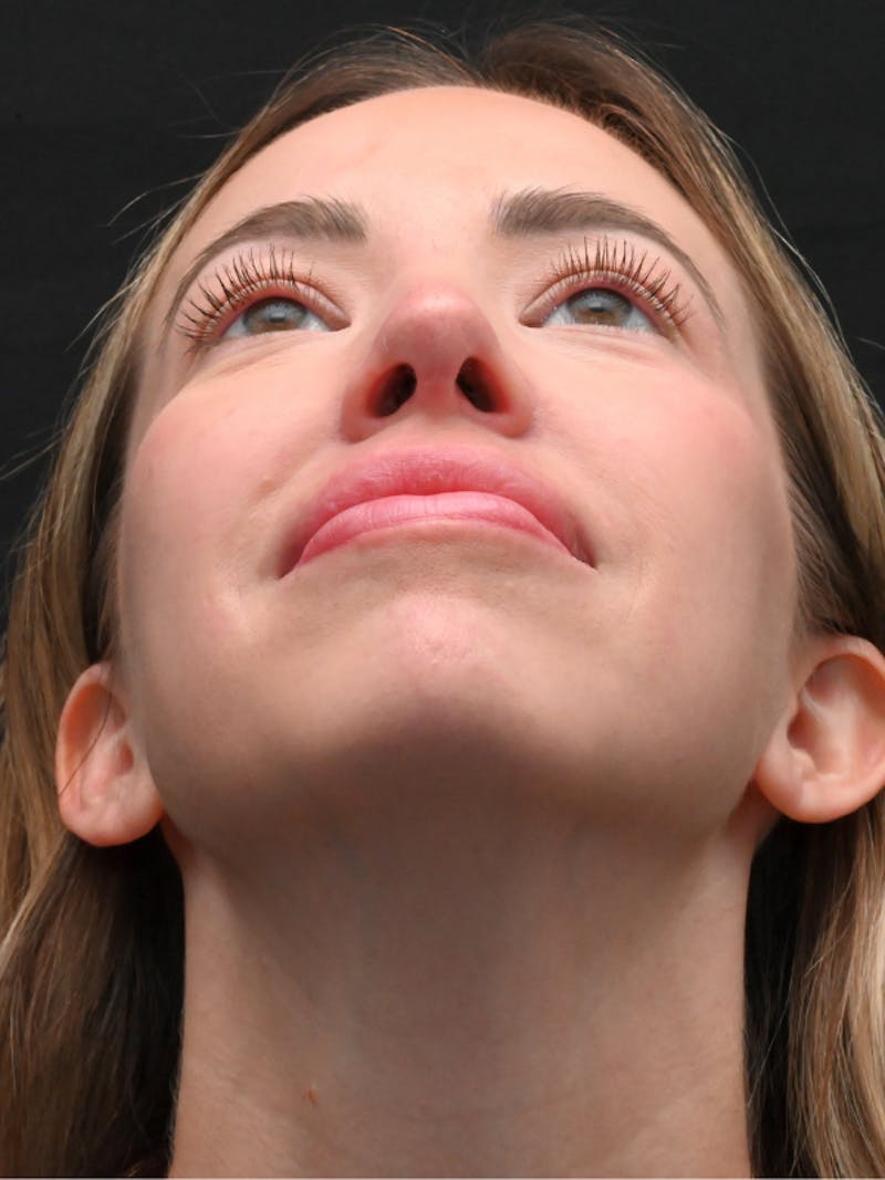 Rhinoplasty Before & After Gallery - Patient 543311 - Image 8