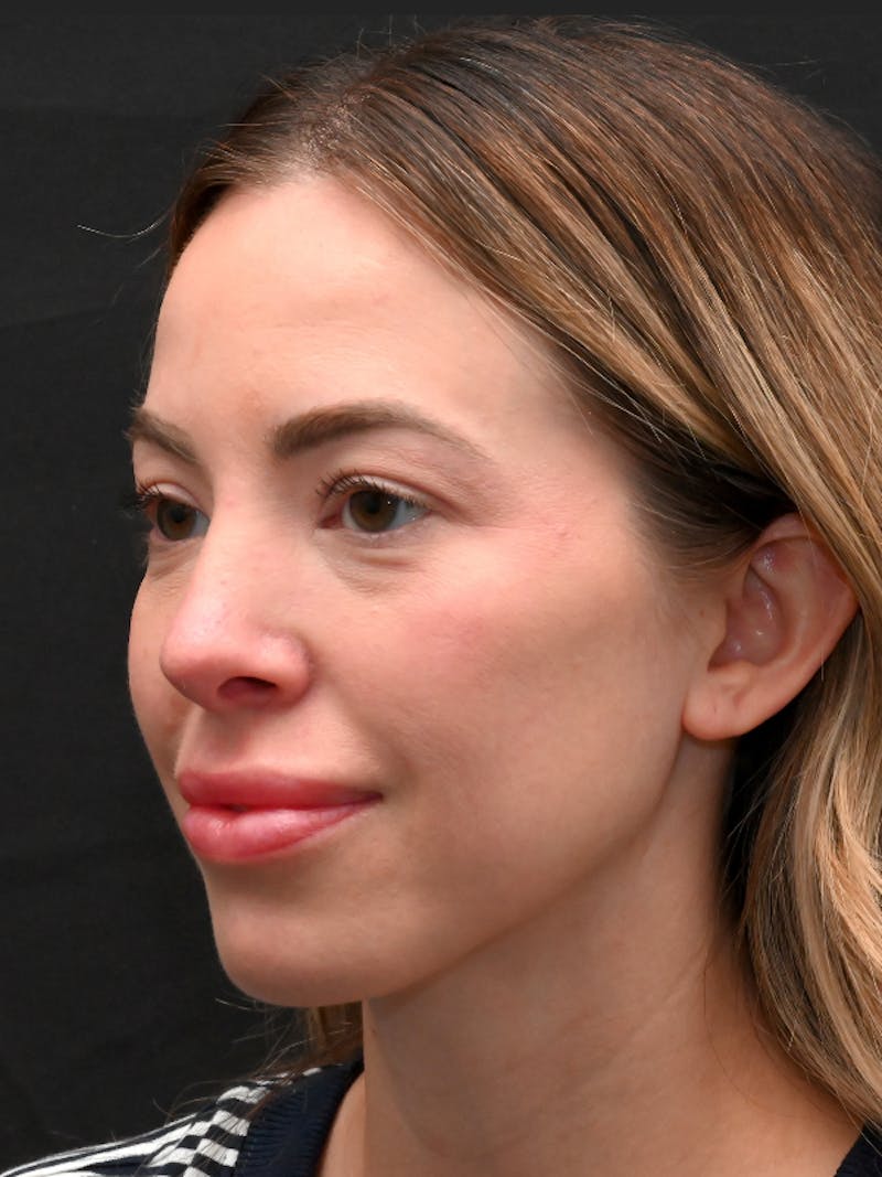 Rhinoplasty Before & After Gallery - Patient 543311 - Image 14