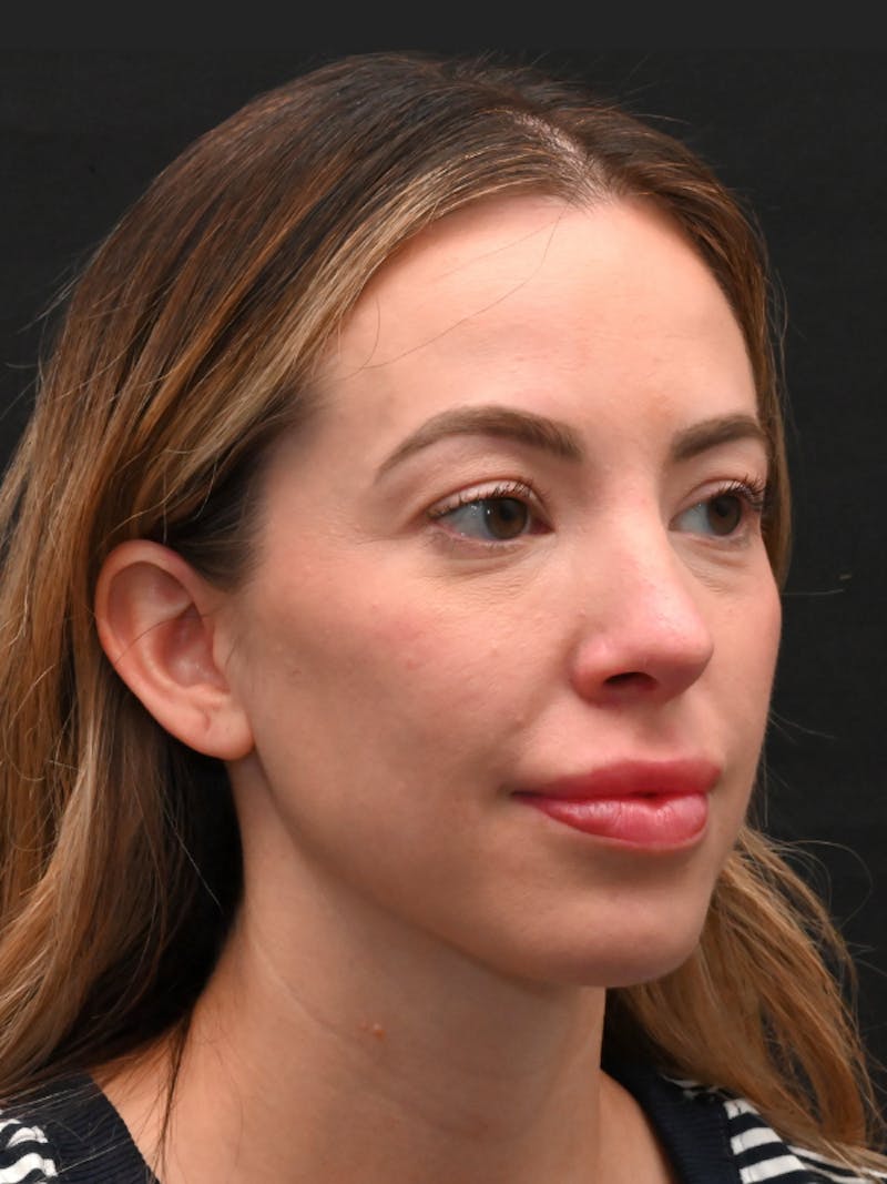 Rhinoplasty Before & After Gallery - Patient 543311 - Image 6