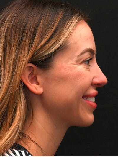 Rhinoplasty Before & After Gallery - Patient 543311 - Image 2