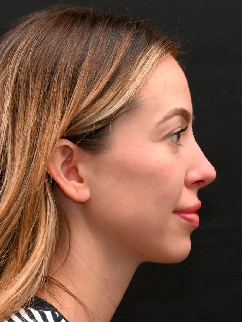 Rhinoplasty Before & After Gallery - Patient 543311 - Image 4