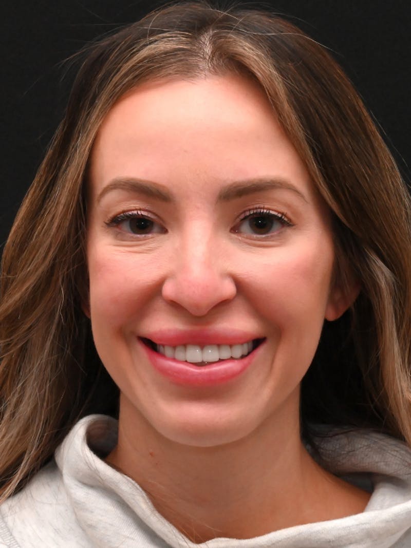 Rhinoplasty Before & After Gallery - Patient 543311 - Image 9
