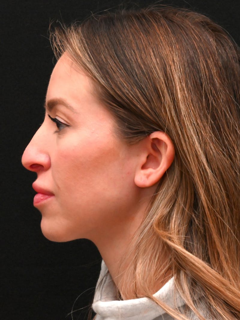 Rhinoplasty Before & After Gallery - Patient 543311 - Image 11