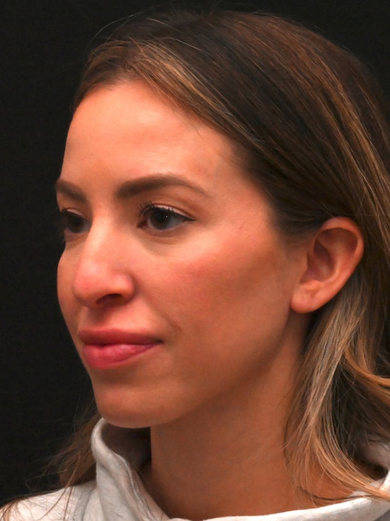 Rhinoplasty Before & After Gallery - Patient 543311 - Image 13