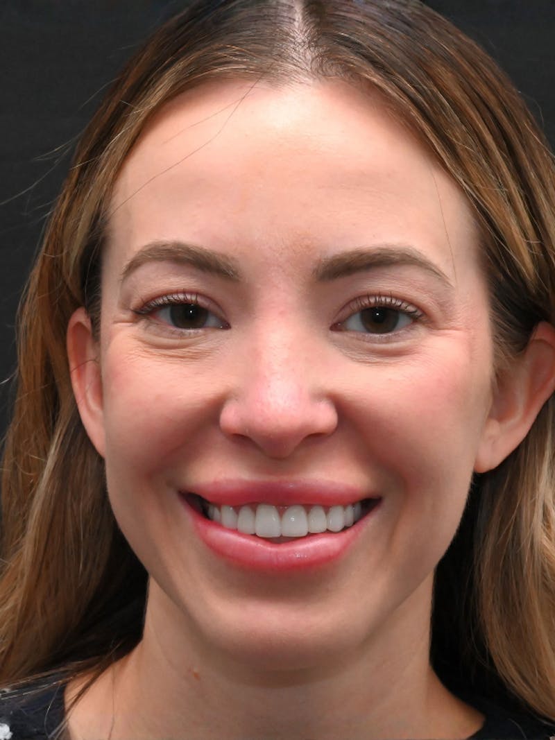 Rhinoplasty Before & After Gallery - Patient 543311 - Image 10