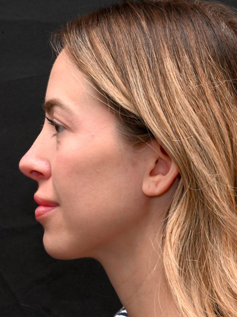 Rhinoplasty Before & After Gallery - Patient 543311 - Image 12
