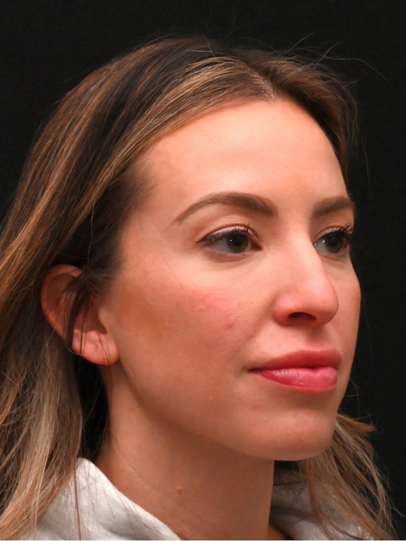 Rhinoplasty Before & After Gallery - Patient 543311 - Image 5