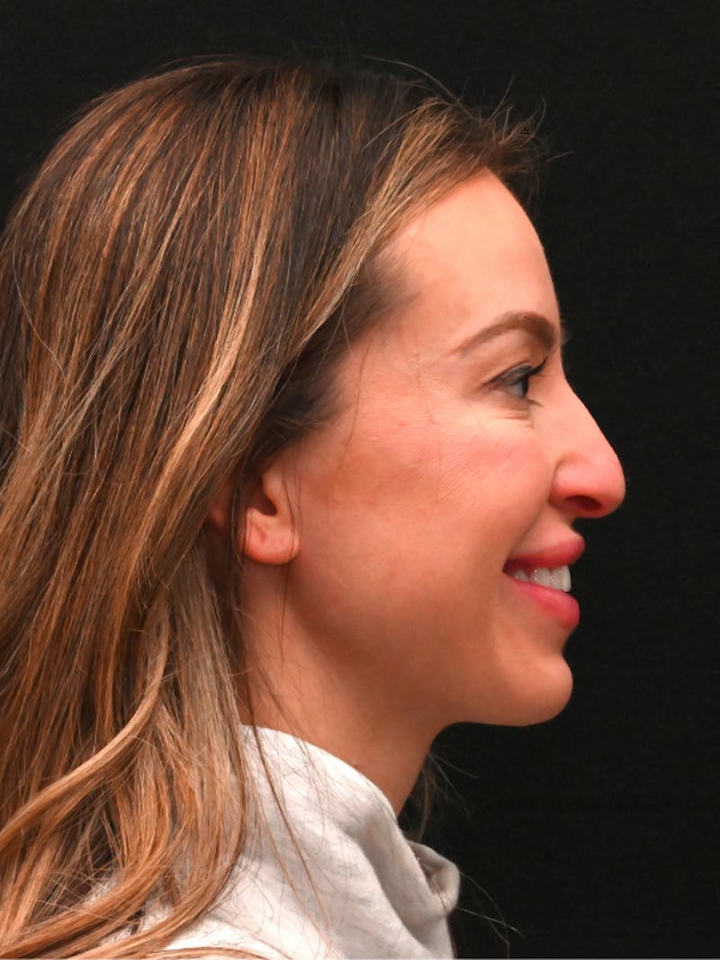 Rhinoplasty Before & After Gallery - Patient 543311 - Image 1