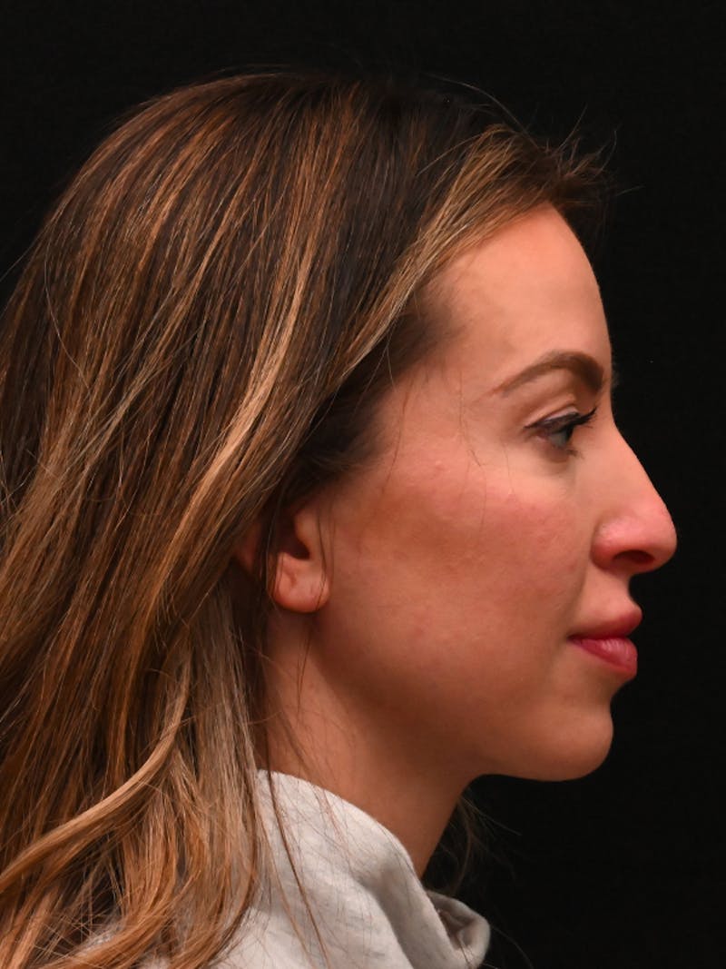 Rhinoplasty Before & After Gallery - Patient 543311 - Image 3