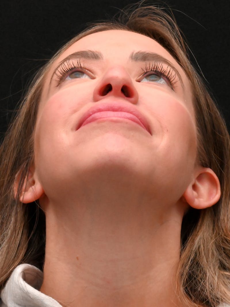 Rhinoplasty Before & After Gallery - Patient 543311 - Image 7